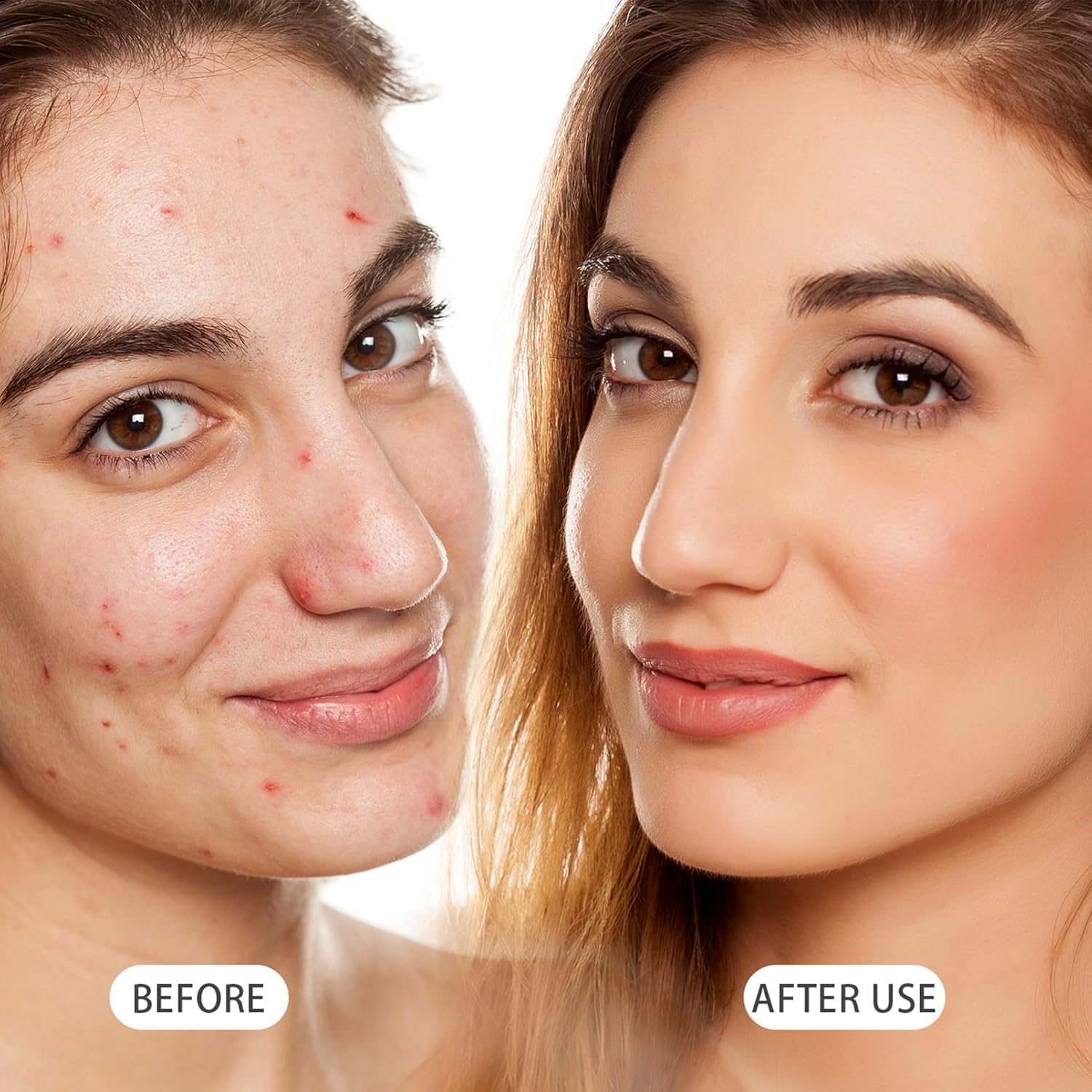HIQUAY Azelaic Acid Serum, 12% Azelaic Acid Enhancer Cream, Hyaluronic Acid Serum and Niacinamide Facial Treatment, For Redness, Dark Spots, Rosacea, And Pore Cleansing (1 Pcs)